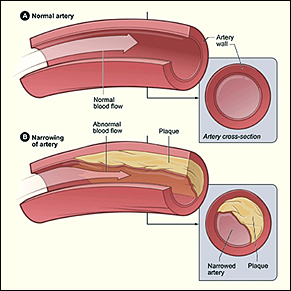 heart disease